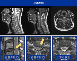 頚椎 Mri 検診 のご案内 Pictoruみたかクリニック 医療法人江田クリニック