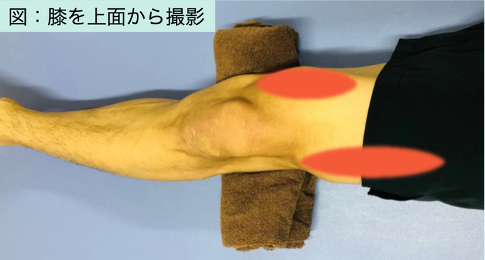 大腿四頭筋の筋力トレーニング（パテラセッティング）